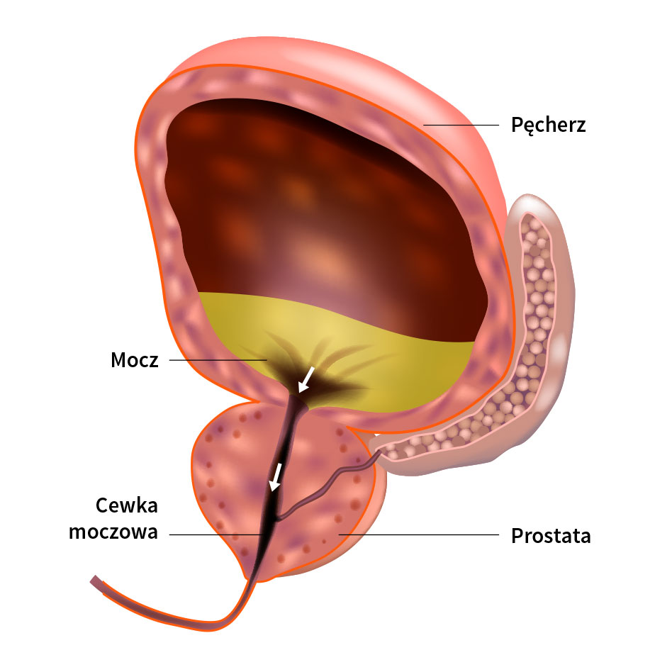 Ilustracja przedstawia anatomię układu moczowego, z wyraźnym zaznaczeniem pęcherza, cewki moczowej oraz prostaty.