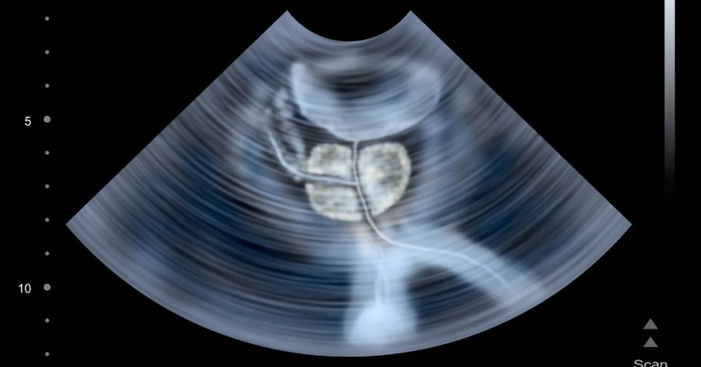 Ultrasonografia układu moczowego, przedstawiająca szczegóły anatomiczne narządów, w tym pęcherza i cewki moczowej.