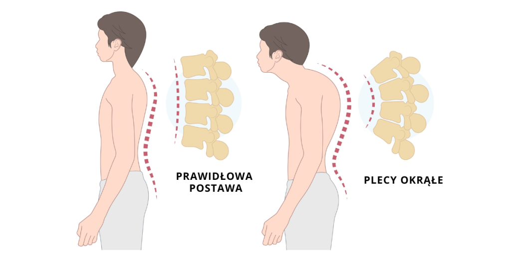 Ilustracja przedstawia różnice między prawidłową postawą ciała a plecami okrągłymi, podkreślając znaczenie właściwej postawy dla zdrowia kręgosłupa.