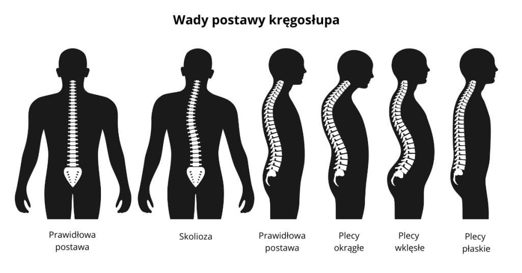 Ilustracja przedstawia różne wady postawy kręgosłupa, w tym skoliozę, plecy okrągłe, wklęsłe oraz płaskie, porównując je z prawidłową postawą.