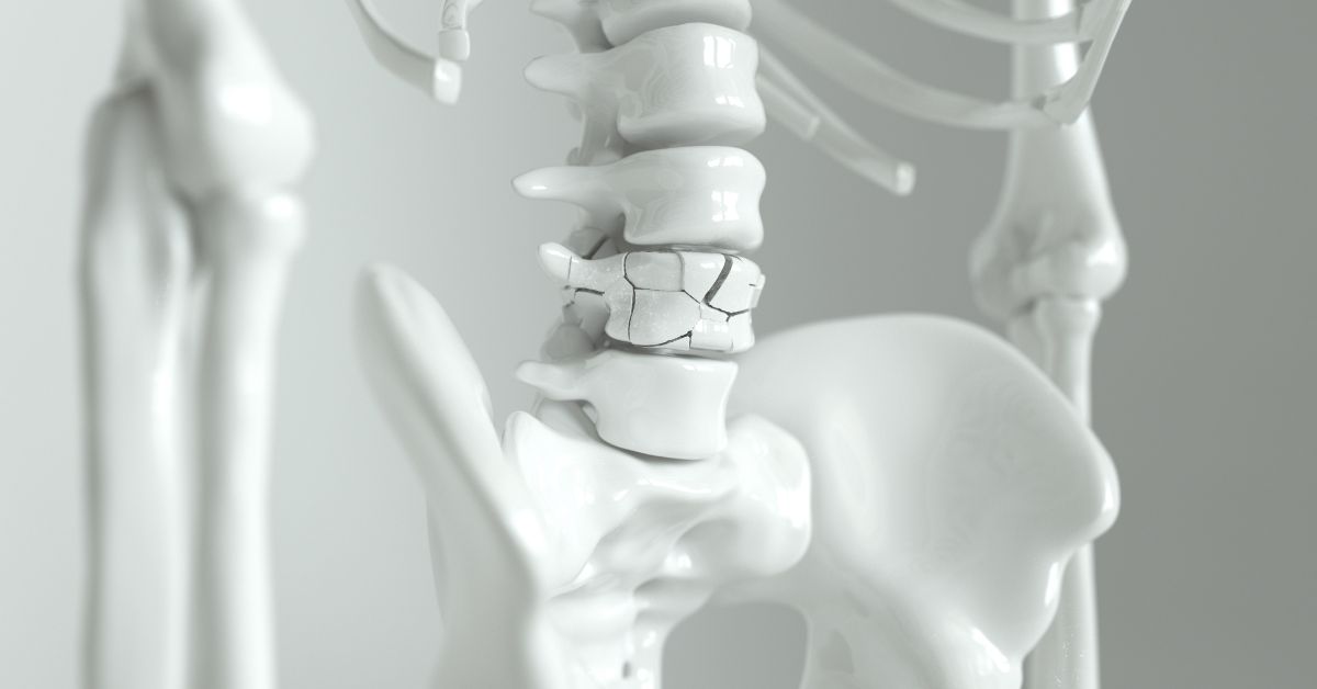 Model anatomiczny układu kostnego z widocznym uszkodzeniem jednego z kręgów, idealny do celów edukacyjnych i medycznych.