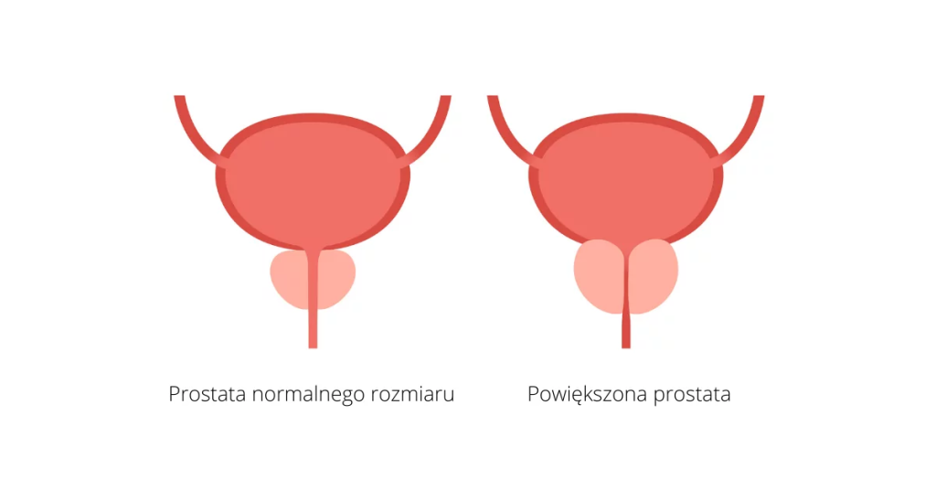 Porównanie obrazu przedstawia normalny rozmiar prostaty oraz powiększoną prostatę, ukazując różnice w ich strukturze.